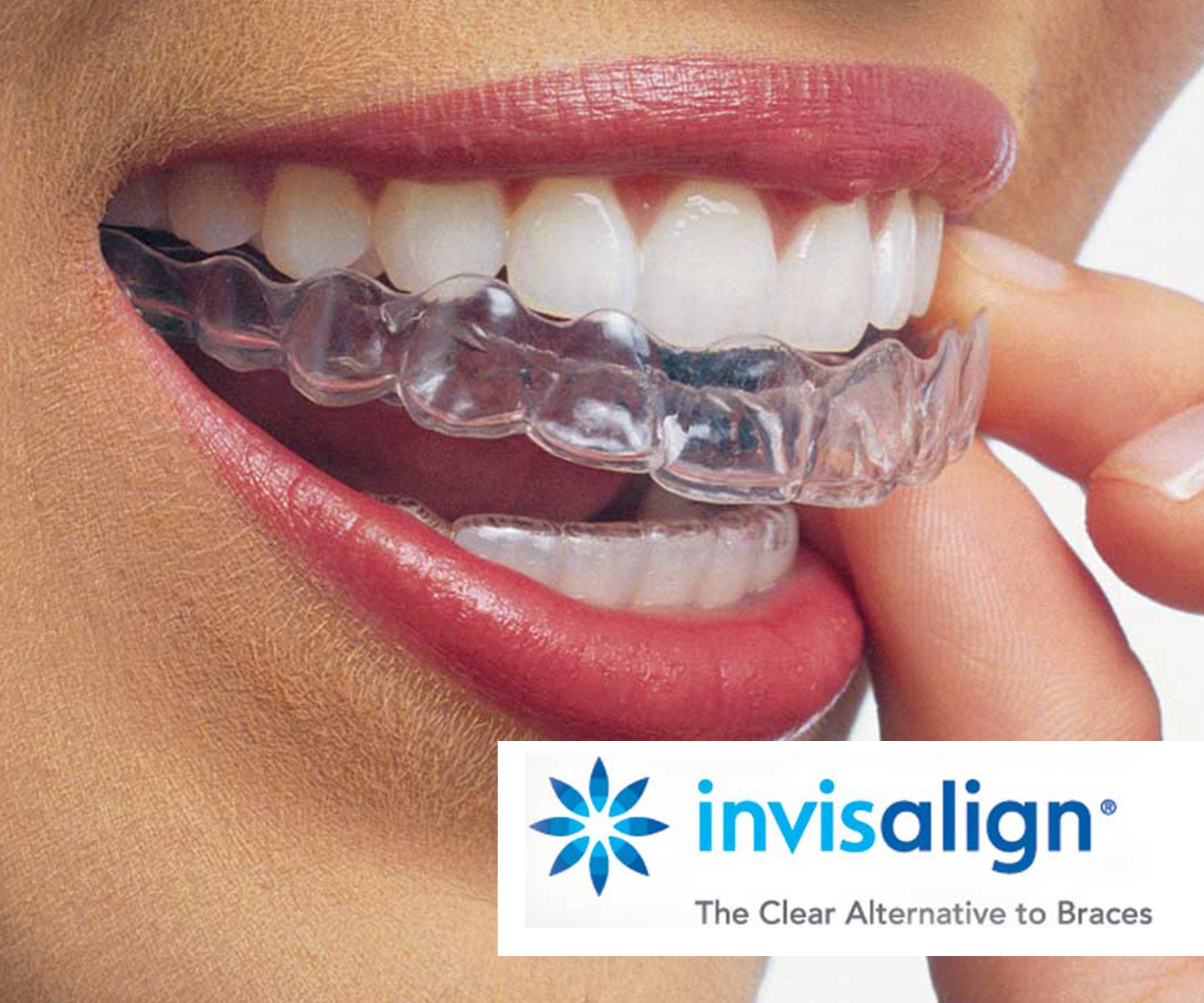 Invisalign - Dr. Von Nell & Kollegen