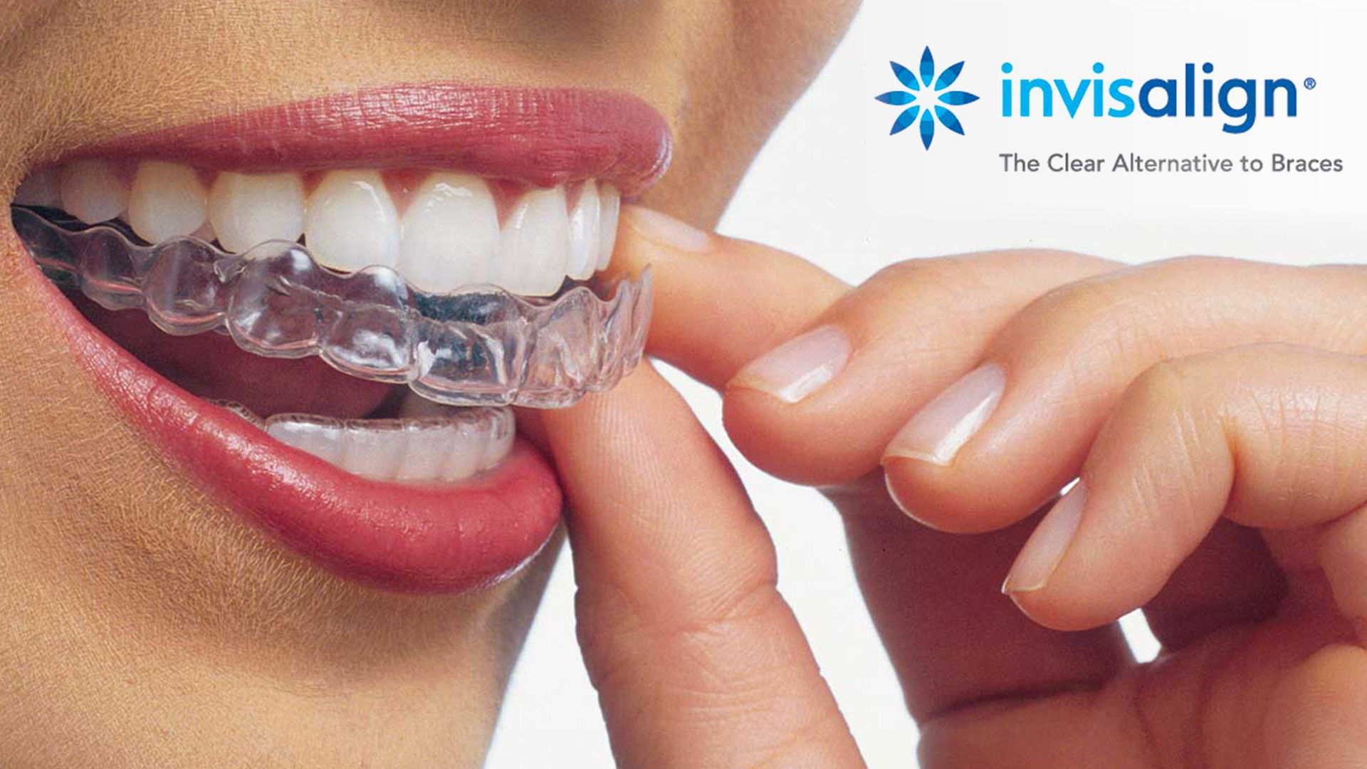 Invisalign - Dr. Von Nell & Kollegen